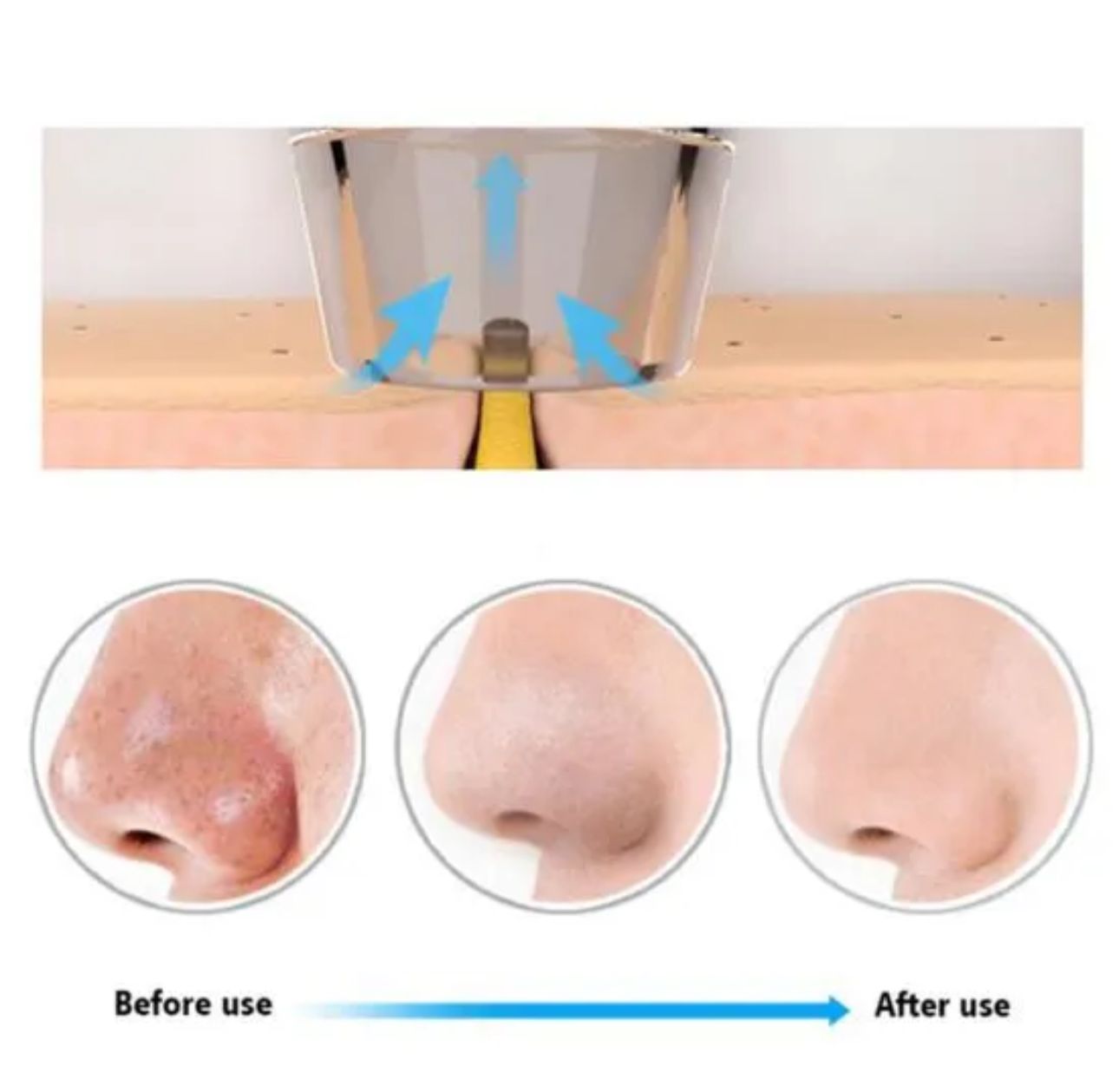 5 in 1 Electric Blackhead Acne Oil Remover Vacuum Suction Face Pore Cleaner Machine